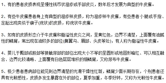 如何通過癥狀表現(xiàn)來診斷判斷牛皮癬