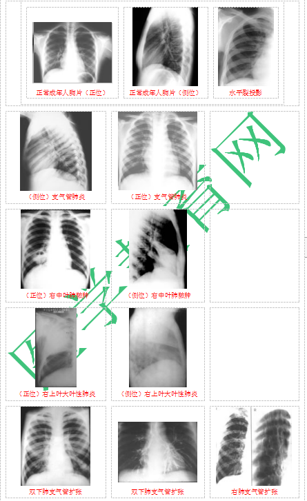 快收藏！臨床助理醫(yī)師實踐技能62個胸片（圖片診斷）