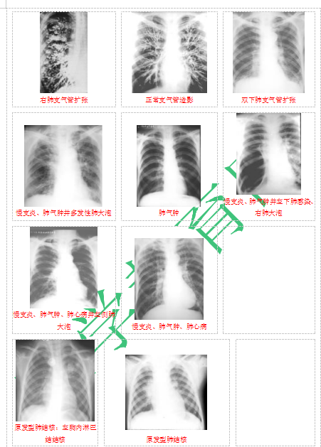 快收藏！臨床助理醫(yī)師實踐技能62個胸片（圖片診斷）