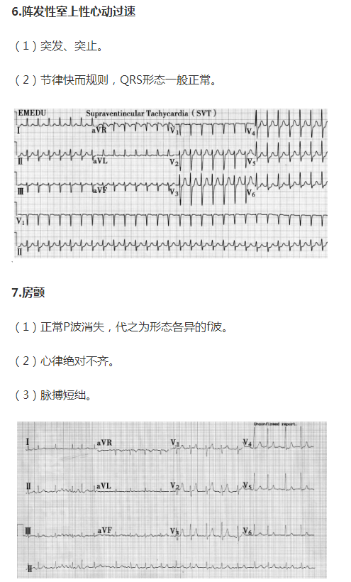 陣發(fā)性心電圖