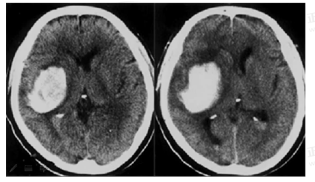 男55歲，左側(cè)肢體偏癱4小時(shí)，有高血壓史，診斷為